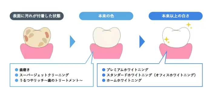 医療機関だからこそできる効果の高いホワイトニング