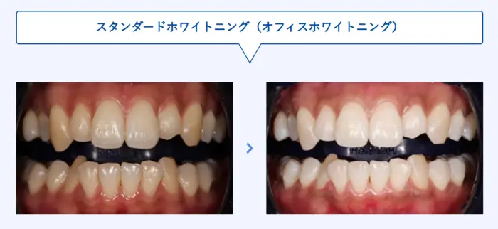 湘南美容歯科のホワイトニング症例