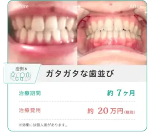 hanaraviの症例