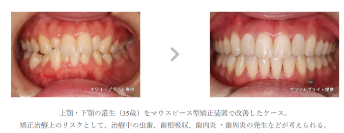 ウィスマイル矯正の事例