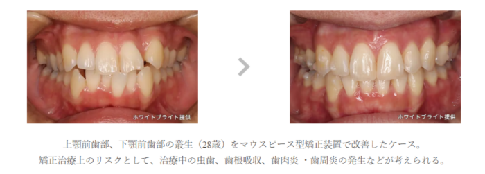ウィスマイル矯正の事例