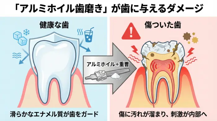 アルミホイルと重曹で歯を磨いた結果、健康で滑らかだったエナメル質が傷つき、汚れが溜まりやすくなった状態を示す比較図