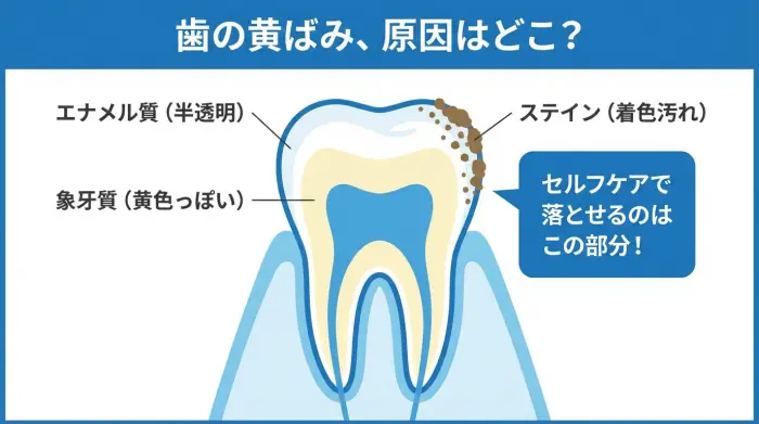 歯の断面図イラスト。エナメル質の表面に付着したステインがセルフケアで落とせる黄ばみの原因であることを示している。