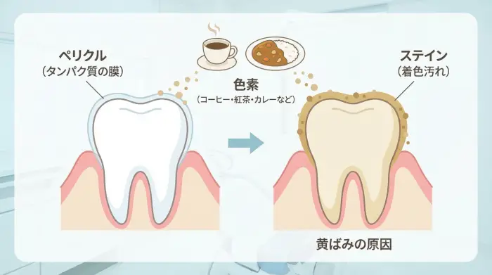 あなたの歯が黄ばむ本当の理由、それは「ステイン」です