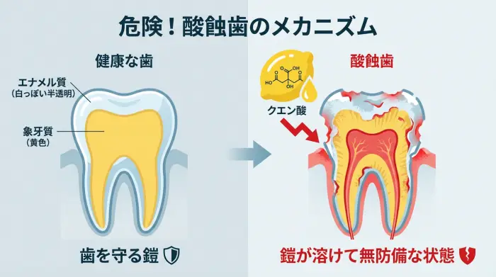 健康な歯と酸蝕歯の断面図の比較イラスト