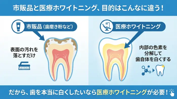 歯の断面図で市販品と医療ホワイトニングの違いを示すインフォグラフィック