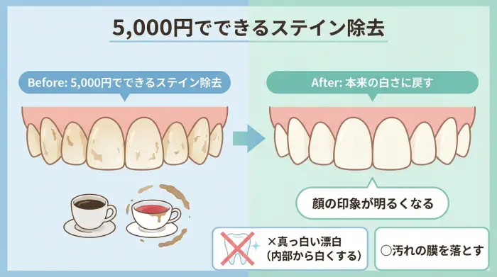 5,000円でできるのは「漂白」ではなく“ステイン除去”まで