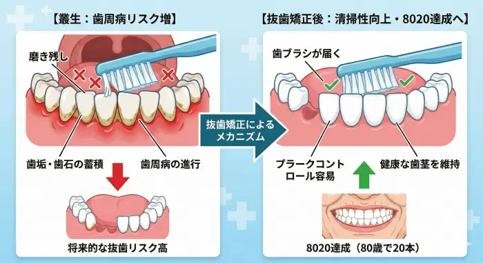 叢生による歯周病リスクと、抜歯矯正による清掃性向上・8020達成のメカニズム比較
