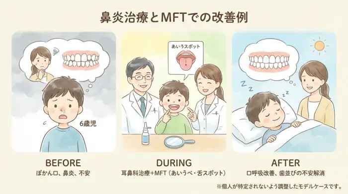 実例：鼻炎の治療＋MFTで「ぽかん口」が改善し、歯並びの不安が減ったケース