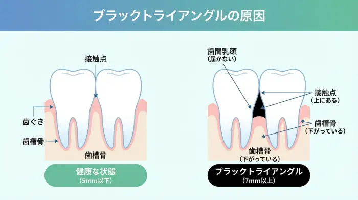 ブラックトライアングルはなぜ起きる？原因を「構造」で理解すると対策が早い