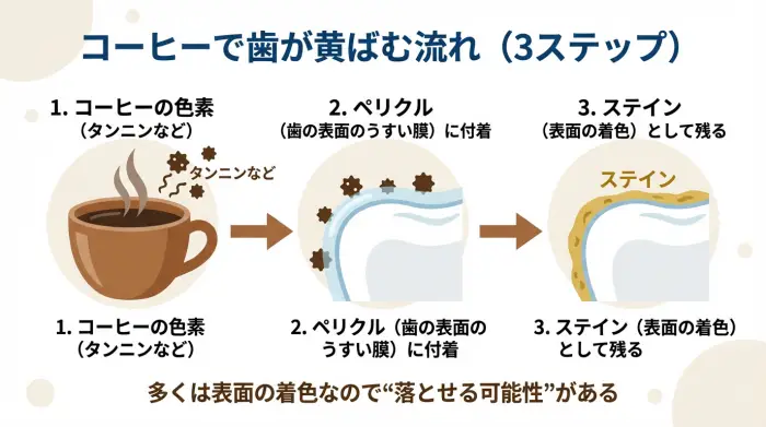 コーヒーの色素が歯表面の膜に付着し、ステインとして黄ばみになる流れ