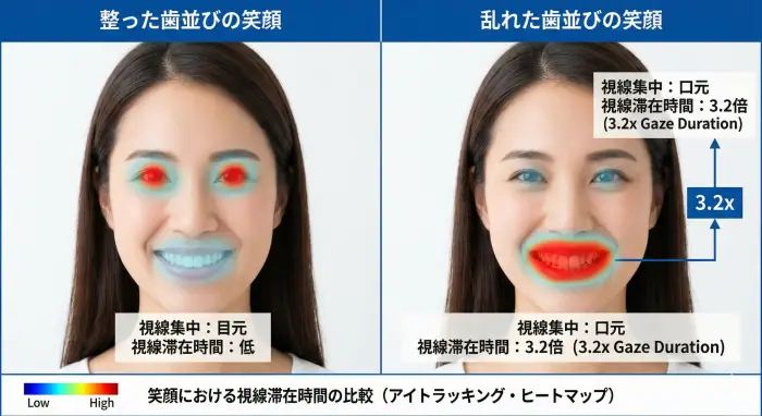 笑顔の際の視線追跡(アイトラッキング)比較図。歯並びの乱れが強い視覚的ノイズとなり、視線滞在時間が目元よりも口元に集中しやすい傾向を示す。
