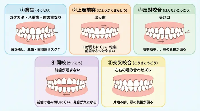 そもそも「歯並びが悪い」とは？代表的な不正咬合タイプ5つ
