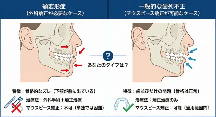 顎変形症（左：下顎が前に出ている・外科手術必須）と一般的な歯列不正（右：歯並びが悪いだけ・マウスピース可）の比較イラスト