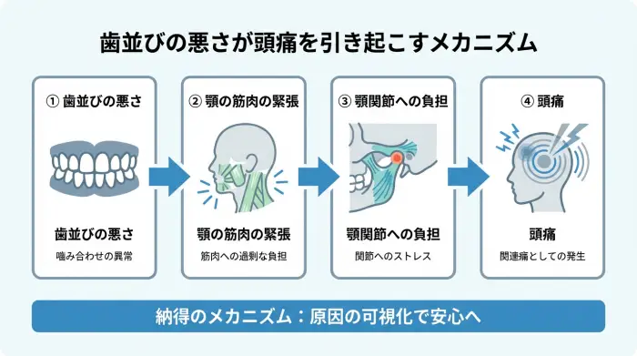歯並びの悪さが頭痛を引き起こすメカニズムを図解したインフォグラフィック。