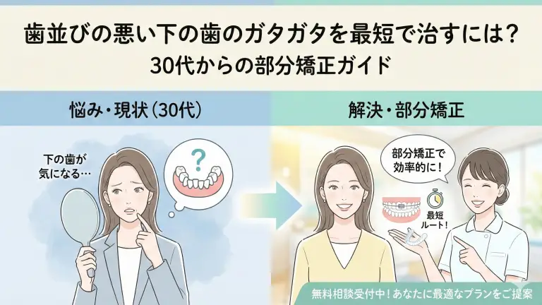 歯並びの悪い下の歯のガタガタを最短で治すには？30代からの部分矯正ガイド