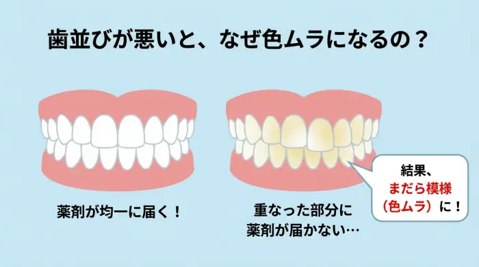 歯並びが悪い状態でホワイトニングをした場合の色ムラ発生リスクを示すイラスト