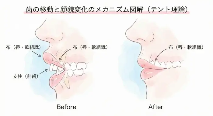 歯列矯正による口元の変化を示した断面図。前歯（支柱）が後退することで唇（テントの布）の突出感が改善されるメカニズム。
