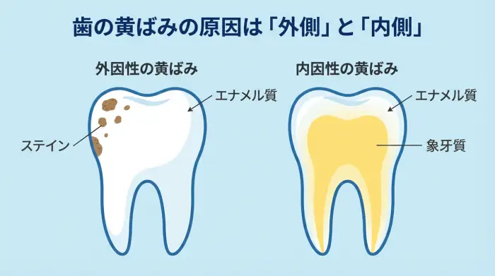 歯の断面図による黄ばみの原因解説。外因性の黄ばみとしてエンティティ「ステイン」が「エナメル質」に付着する関係性を、内因性の黄ばみとして「象牙質」の色が透ける様子を視覚的に示している。