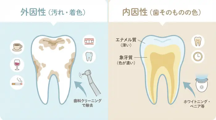 歯の黄ばみは「汚れ」と「歯の色」の2種類がある