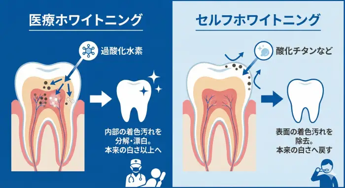 「医療ホワイトニング」と「セルフホワイトニング」の本質的な違いという論理関係を視覚的に表現した図解。左側では、医療ホワイトニングが歯を内側から漂白する仕組みを示し、右側ではセルフホワイトニングが歯の表面の着色汚れを除去するに留まる仕組みを示しています。