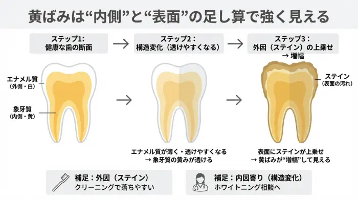 エナメル質と象牙質の関係と、ステインが重なると黄ばみが強く見える仕組みの図