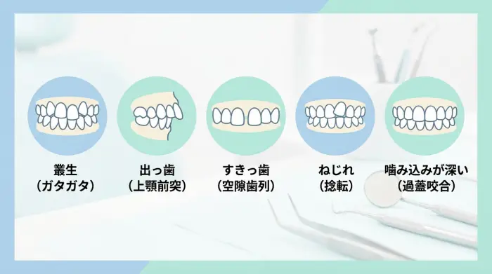 マウスピース vs 裏側矯正、徹底比較で見る最適解