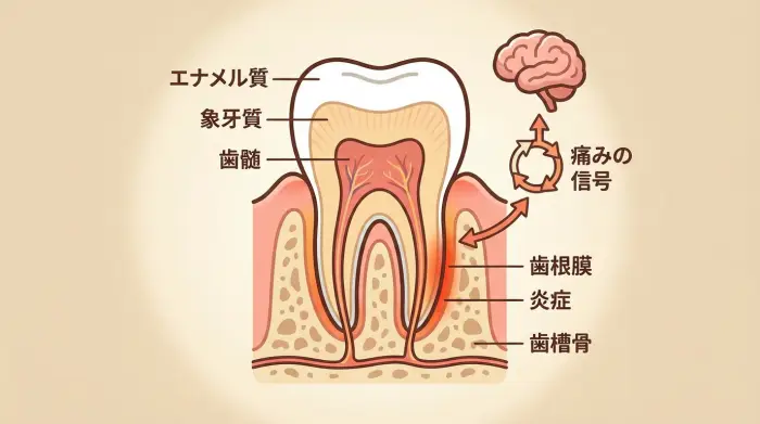 マウスピース矯正で痛みが出る仕組みの図解。エンティティ「アライナー」が歯に力を加えるという【原因】によって、エンティティ「歯根膜」に炎症が起きるという【結果】を視覚的に表現している。