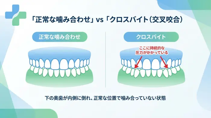 奥歯が内側に傾く3つの主な原因｜特に多いのが「無意識の噛み締め」です