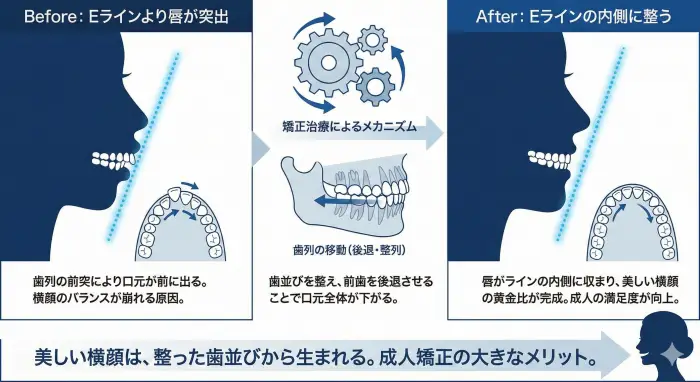 歯列矯正による横顔（Eライン）の変化を示す比較図。歯列の移動が横顔のバランスを整え、成人の満足度を最大化する関係を表現。