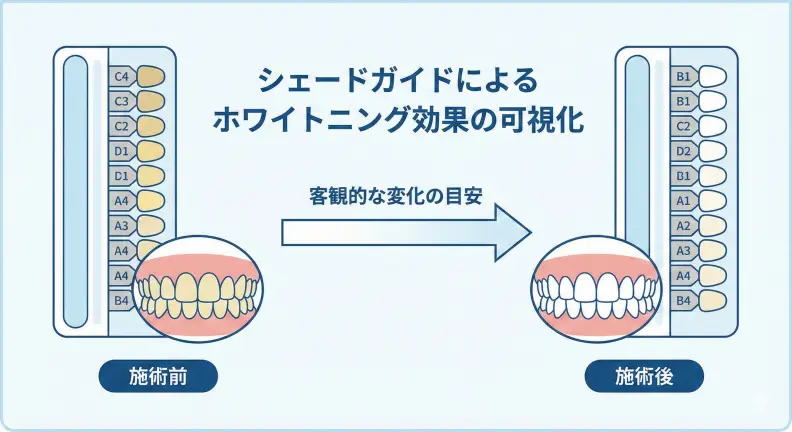 オフィスホワイトニングの効果測定に使われるシェードガイドの図解。エンティティ「オフィスホワイトニング」の効果を、エンティティ「シェードガイド」という客観的指標で2〜4段階明るくなるという関係性として視覚的に表現している。
