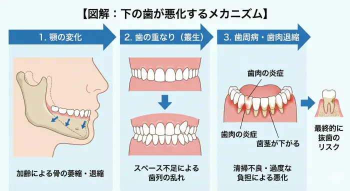 下の歯が悪化するメカニズム