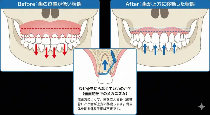 垂直的圧下のメカニズム