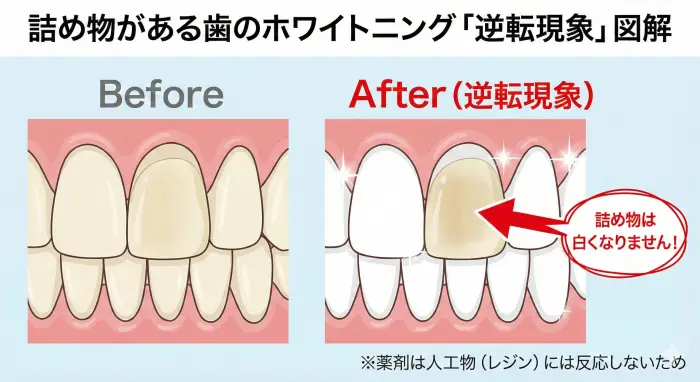 前歯に詰め物がある場合のホワイトニング失敗例（逆転現象）の図解。ホワイトニング薬剤はコンポジットレジン（人工物）には作用しないため、天然歯だけが白くなり、結果として詰め物がシミのように目立ってしまうメカニズムを視覚化している。