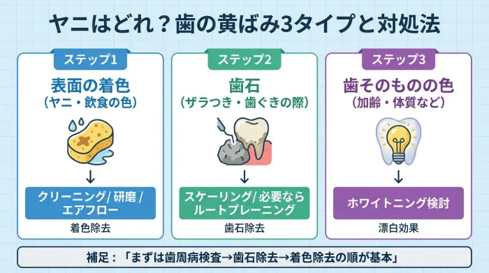 ヤニ取りは着色か歯石かを見分け、歯医者のクリーニング方法を選ぶ図解
