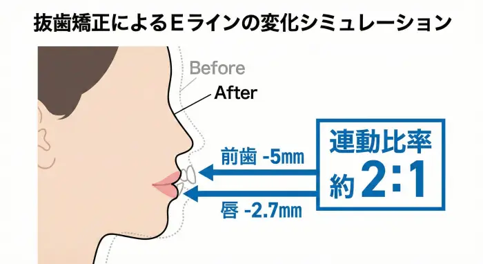抜歯矯正による横顔の変化シミュレーション図。前歯の後退に伴い、約1:0.54の比率でEラインの変化が生じる様子を示している。