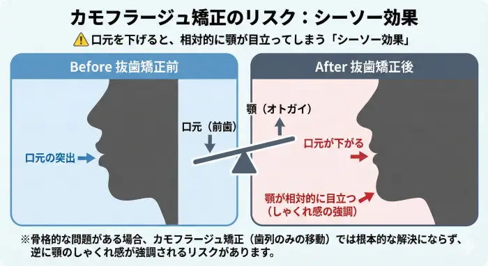 カモフラージュ矯正のリスクであるシーソー効果の解説図。抜歯矯正で口元を大きく下げた結果、相対的に顎（オトガイ）が前方に取り残され、しゃくれ顔が強調されてしまうメカニズムをシルエットで表現。