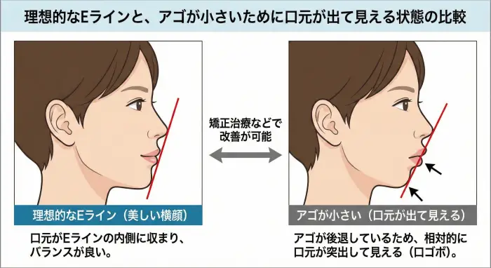 理想的なEライン（左）と、アゴが小さいために口元が出て見える状態（右）