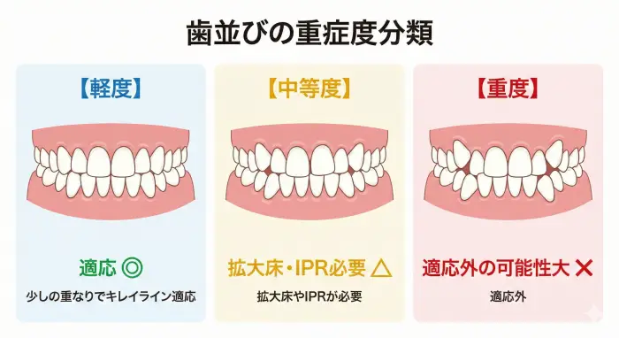 歯並びの叢生（ガタつき）レベル分類図。軽度は少しの重なりでキレイライン適応、中等度は拡大床やIPRが必要、重度は適応外。