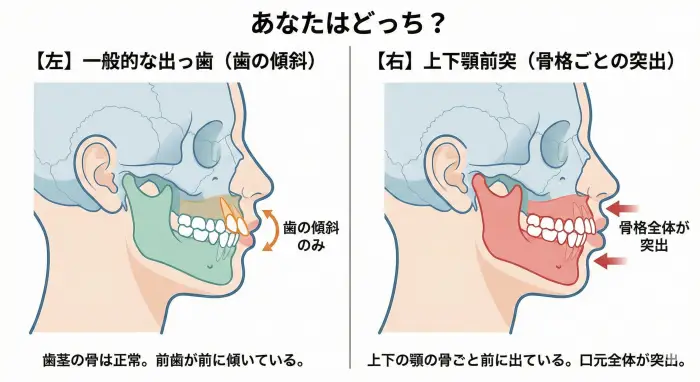 【左】一般的な出っ歯（歯の傾斜） vs 【右】上下顎前突（骨格ごとの突出）