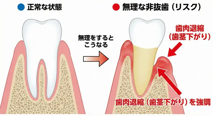 歯肉退縮（歯茎下がり）のリスク図解