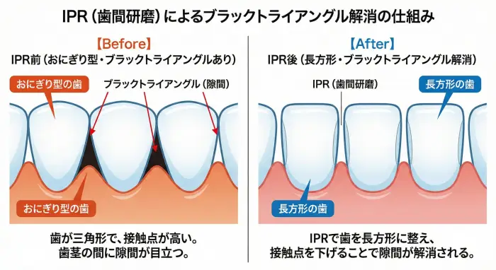 IPRでおにぎり型の歯を長方形に整え、コンタクトポイントを下げることでブラックトライアングルが解消される仕組み