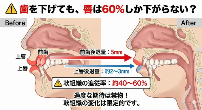 歯科矯正における「軟組織の追従率」の解説図。前歯（硬組織）を5mm後退させても、上唇（軟組織）は約2mm〜3mm（移動量の40-60%）しか下がらないことを示しており、過度な期待に対する注意喚起を表している。