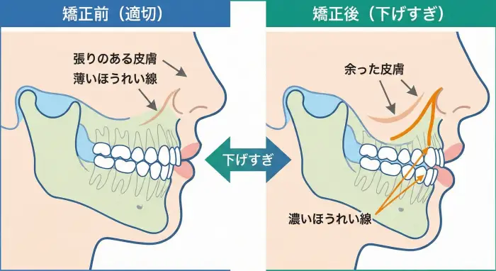 口元の矯正による「下げすぎ」が原因で、皮膚が余りほうれい線が濃くなるメカニズムの比較イメージ図