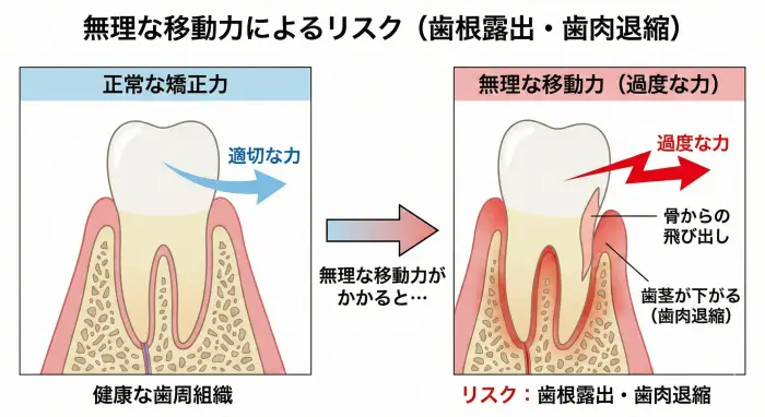 無理な移動力がかかると、歯根が骨から飛び出し、歯茎が下がってしまうリスクがある