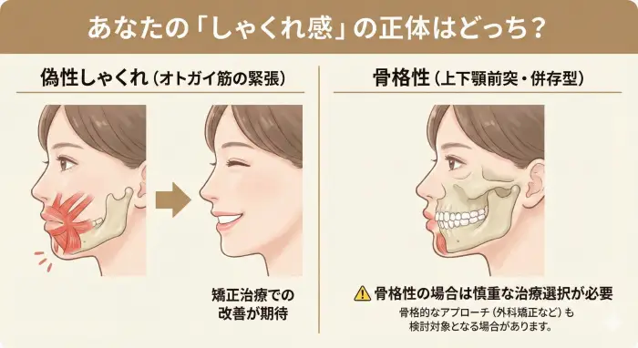 オトガイ筋の緊張による偽性しゃくれと、骨格的な上下顎前突（併存型）の比較イラスト。オトガイ筋が原因の場合は矯正治療での改善が期待できるが、骨格性の場合は慎重な治療選択が必要であることを示している。