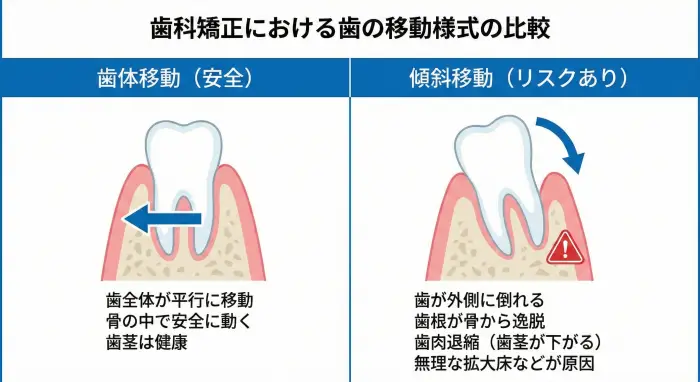 歯科矯正における歯の移動様式の比較図。左側は歯全体が平行に動く「歯体移動」で安全だが、右側は成人に拡大床を無理に使用した場合の「傾斜移動」を示している。傾斜移動では歯が外側に倒れ、歯根が骨から逸脱して歯肉退縮（歯茎が下がる）を引き起こす様子が描かれている。