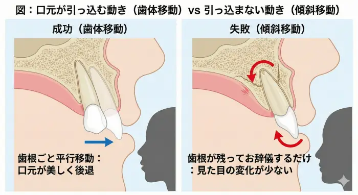 歯根ごと平行移動する「成功（歯体移動）」と、歯根が残ってお辞儀するだけの「失敗（傾斜移動）」の比較断面図。