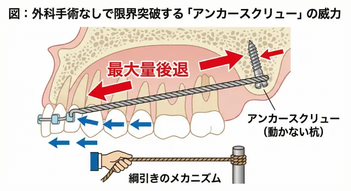 アンカースクリューが「動かない杭」となり、前歯を最大量後退させる綱引きのメカニズム図。