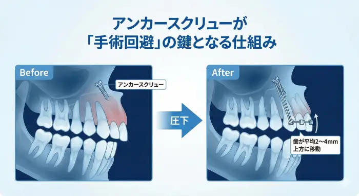 歯科矯正用アンカースクリューを用いて、上の前歯を上方向に移動させ（圧下）、ガミースマイルを改善する前後の比較イラスト。